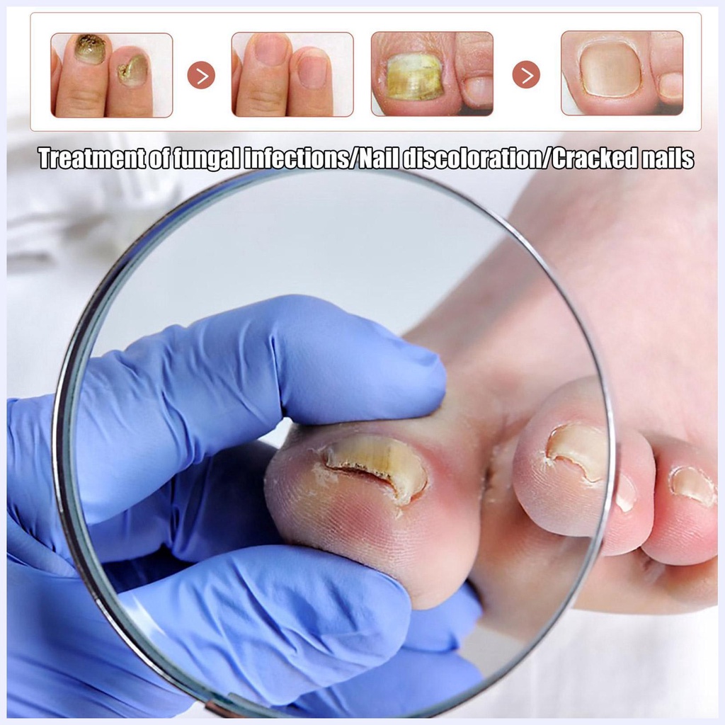Tinh Chất Phục Hồi Móng Chân Mọc Nhanh Và Cải Thiện Móng Bị Nứt Nẻ