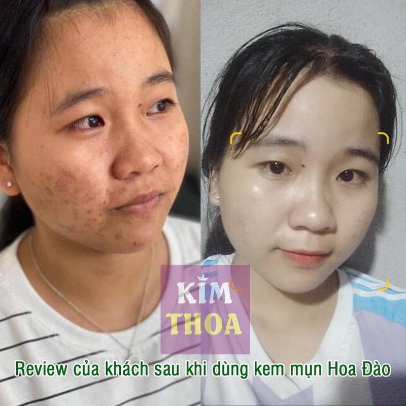 Kem mụn đông y Hoa Đào Full size sạch mụn, ngừa thâm và dưỡng trắng da