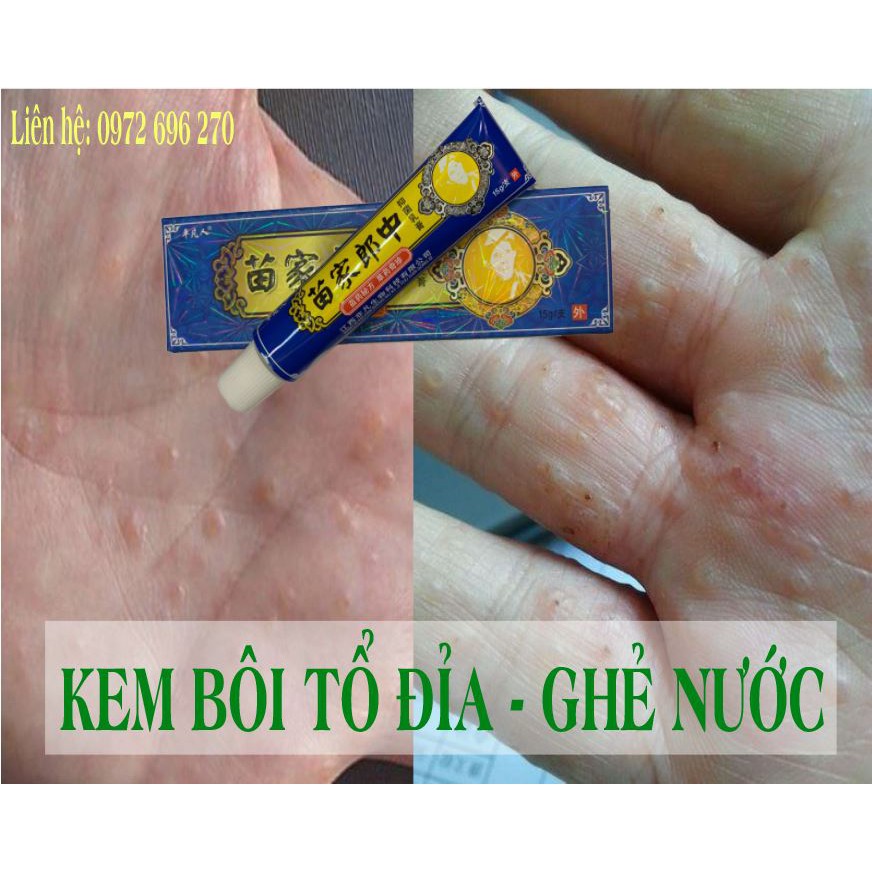 KEM BÔI TỔ ĐỈA - GHẺ NƯỚC [ CỰC HIỆU QUẢ ] SẢN PHẨM CÓ SẴN