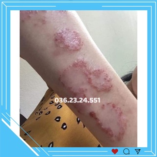 Kem bôi nấm ngứa, tổ đỉa, hắc lào, lang ben, vảy nến, á sừng, các vấn đề về da HÀNG CÓ SẴN