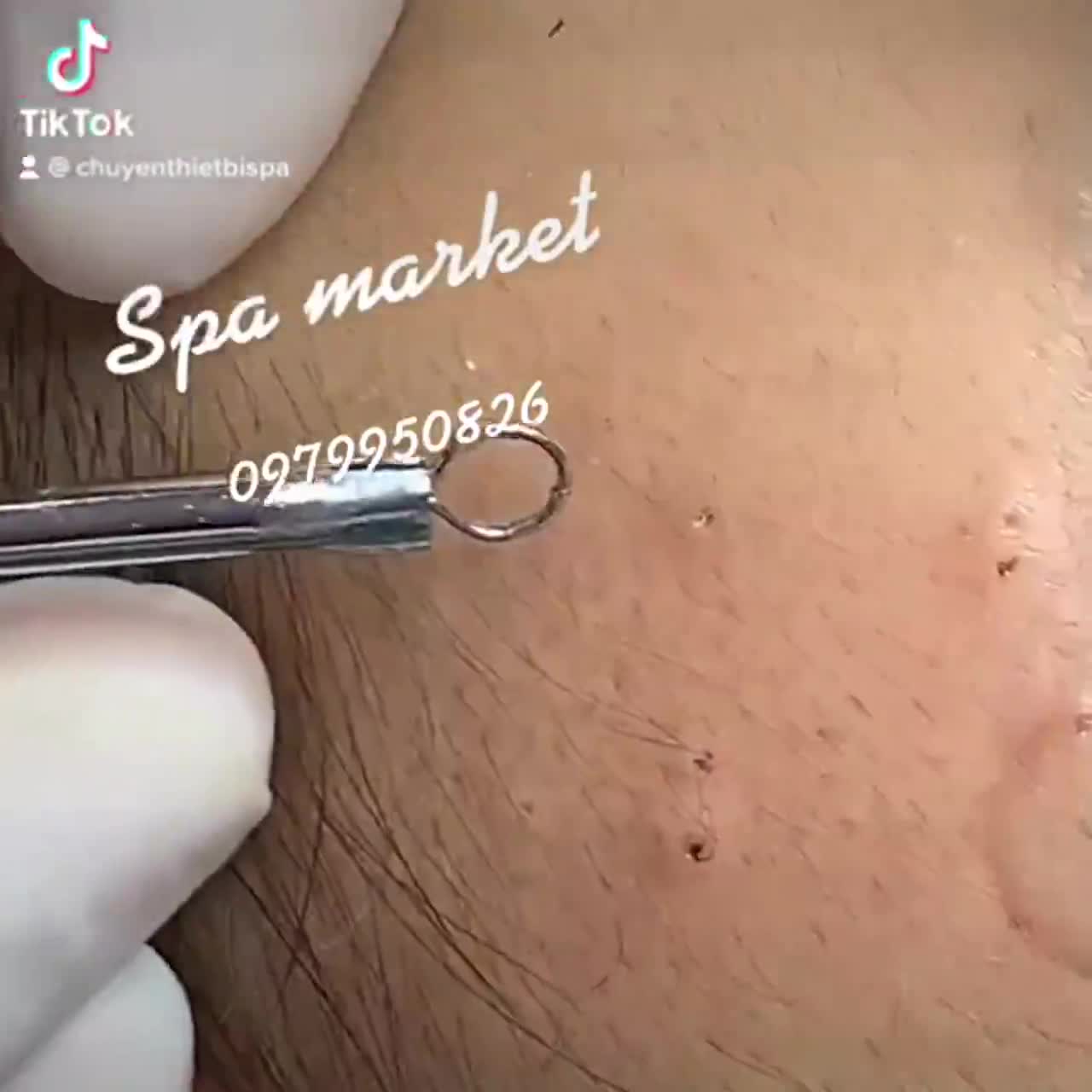 QUE NẶN MỤN MALIKA HÀNG CHUẨN CHUYÊN DÙNG TRONG SPA, THẨM MỸ VIỆN | BigBuy360 - bigbuy360.vn