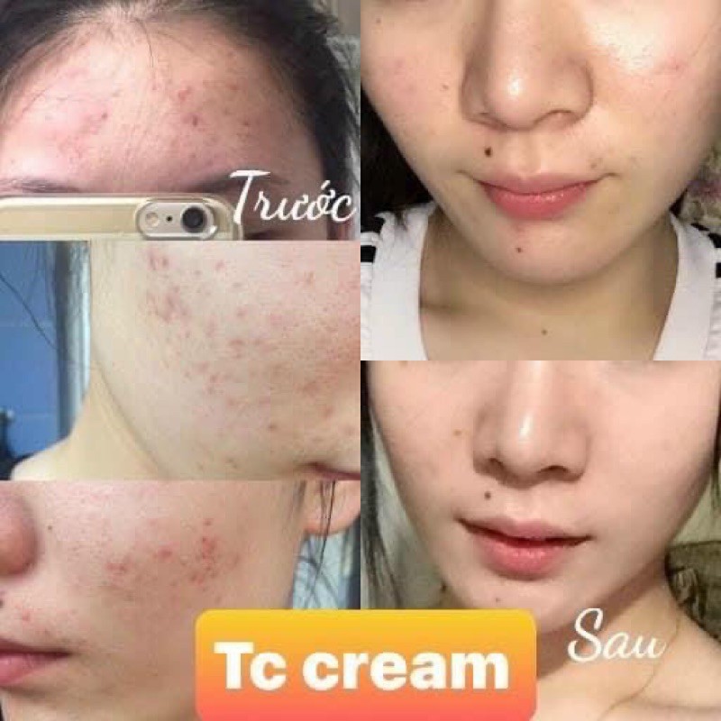 Kem mụn mờ thâm - trắng da centella TC cream mẫu mới