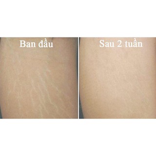 Kem trị rạn da Palmer's Cocoa Butter Formula Stretch Marks