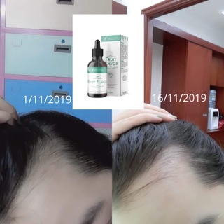 Combo kích mọc tóc Brancos - Mọc tóc nhanh, dày, chắc khỏe