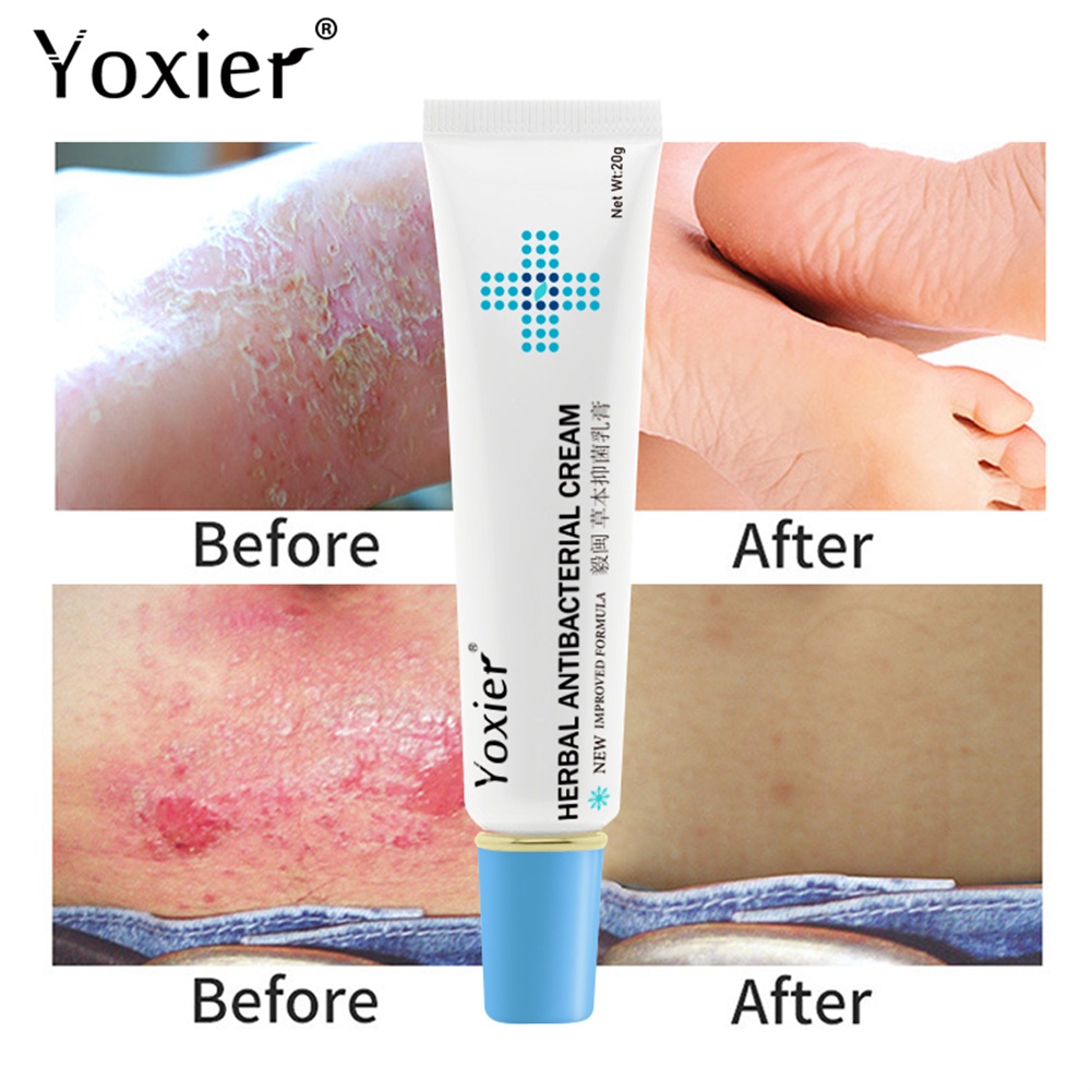 Yoxier Kem Thảo Dược Kháng Khuẩn Kem Trị Chàm Kem Trị Vảy Nến Kem Chống Ngứa Kem Trị Viêm Da 20G Uni