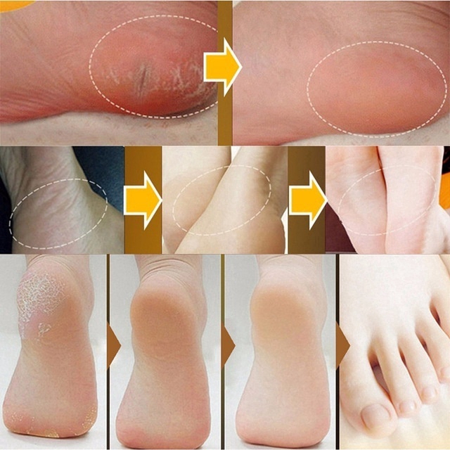 Kem hỗ trợ giảm nứt gót chân 20g