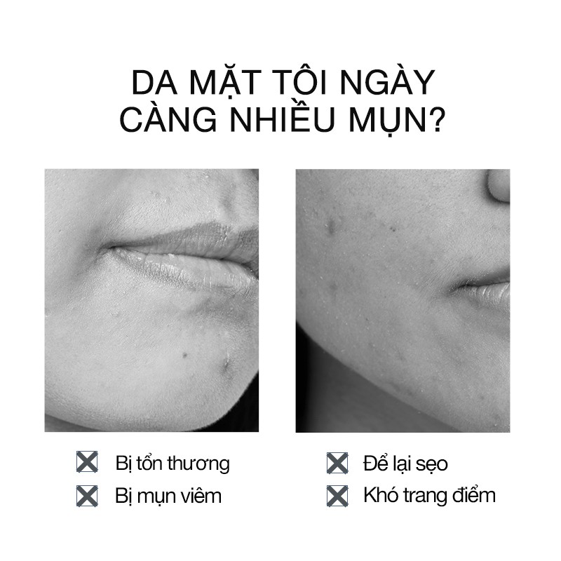 Miếng dán mụn Adsorption Cleansing Acne-fighting Abby's Choice 3 miếng | BigBuy360 - bigbuy360.vn
