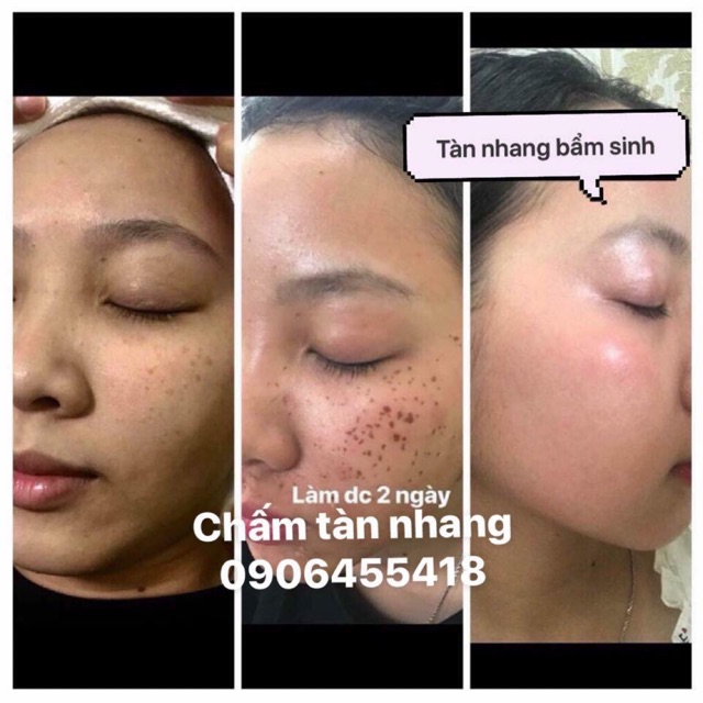 CHẤM CHÂN TÀN NHANG,NỐT RUỒI,MỤN THỊT