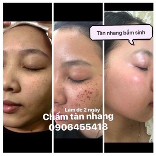 CHẤM CHÂN TÀN NHANG,NỐT RUỒI,MỤN THỊT