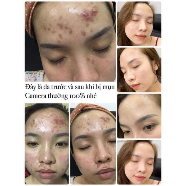 [ Chính Hãng 100% ] Cao Mụn Sâm Đỏ 36vị Đông Y full size | BigBuy360 - bigbuy360.vn