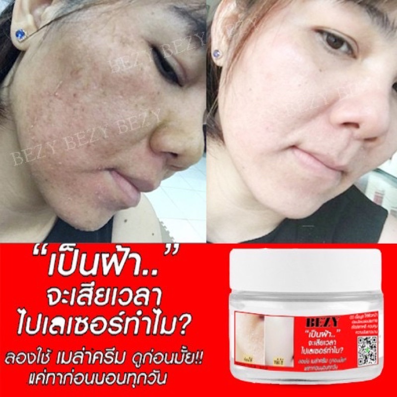 Kem Bong Nám Tái Tạo Da BEZY đẹp da sau 7 ngày