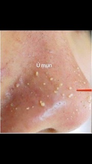 Ủ MỤN ĐẦU ĐEN YOUNGERC
