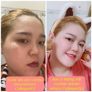 Combo Kem Collagen X3 Đông Anh