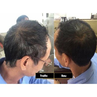 Dầu Gội Phủ Bạc Matrix Gội là Đen tóc 5 gói