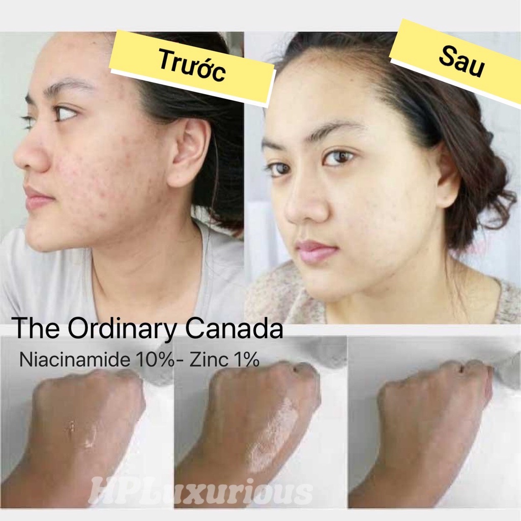 SERUM (Niacinamide10%+Zinc1%) ngừa mụn ,se khít, sáng da The Ordinary 30ml | BigBuy360 - bigbuy360.vn