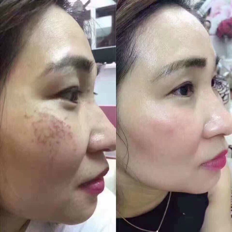 Tinh chất đông y , ko sưng , đỏ .Chuyên mụn , nám , tàn nhang , trắng da , đều màu da , se khít lỗ chân lông handmande