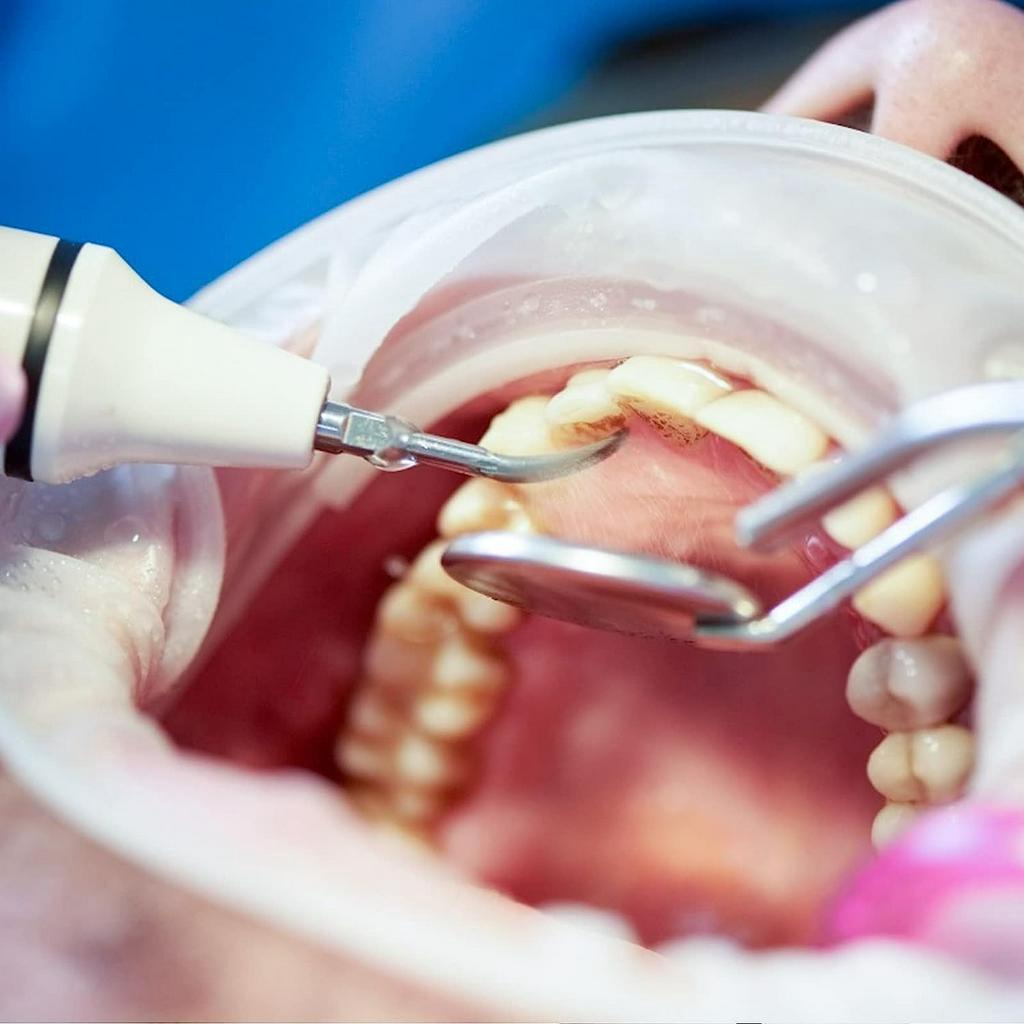 1 Đầu Cân Điện Siêu Âm Cho Nha Khoa