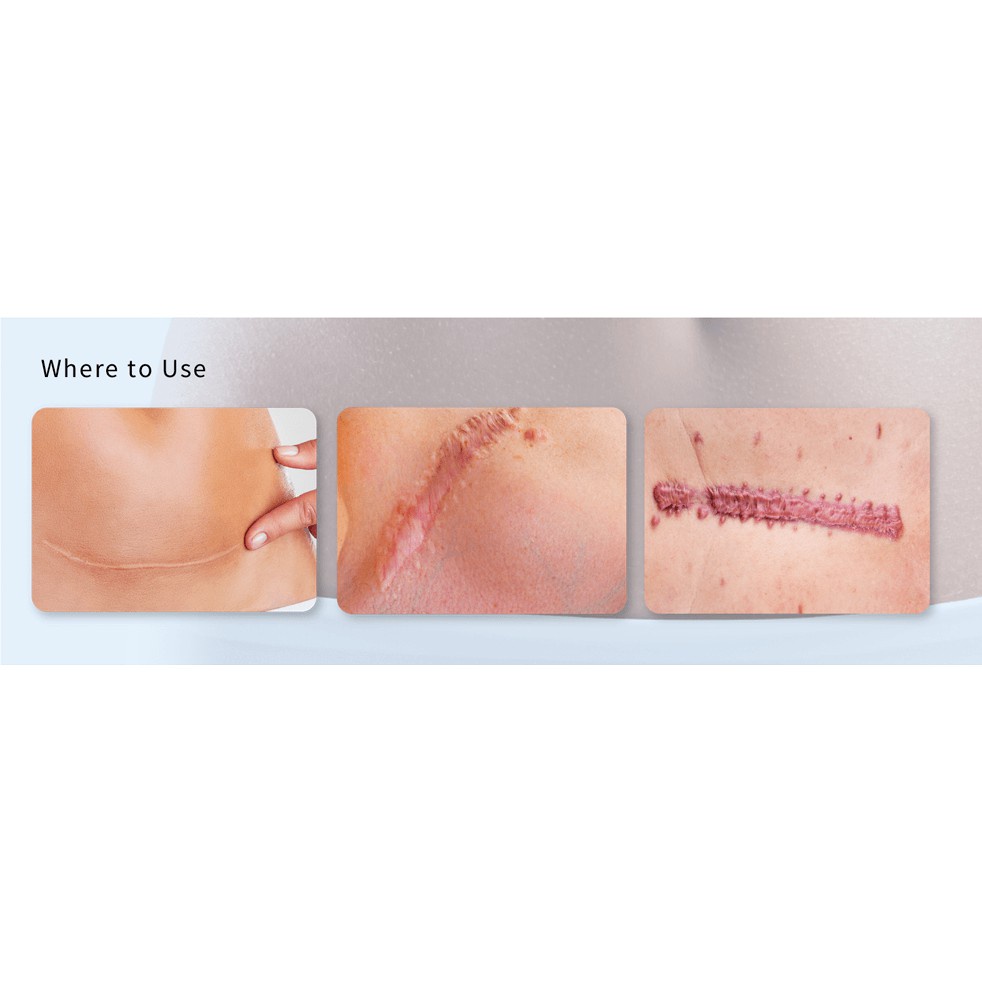 Forscar - sp chăm sóc sẹo được tin dùng tại châu Âu & Mỹ