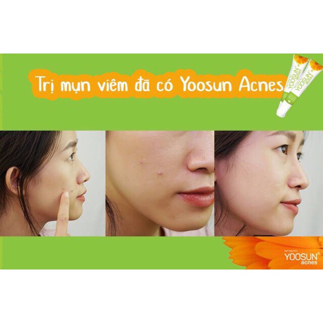 Kem ngừa mụn YOOSUN ACNES | BigBuy360 - bigbuy360.vn