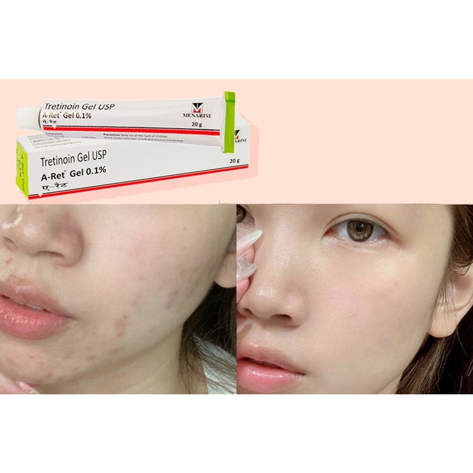 Gel Tretinoin Menarini USP Giảm Mụn, Mờ Thâm Chống Lão Hoá 20g