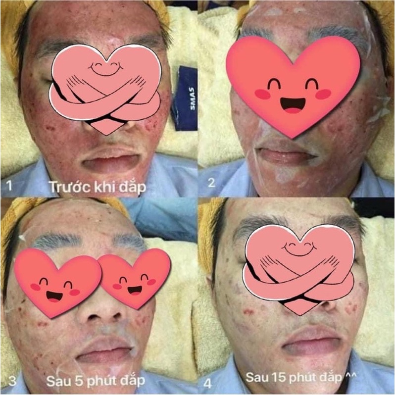 Mặt Nạ Dưỡng Và Phục Hồi Da SMAS Peptide Silk Mask