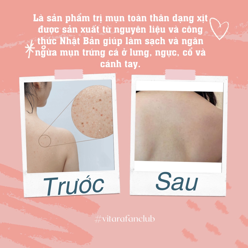 Xịt mụn lưng Vitara SE Body Acne Spray giảm mụn lưng, ngực, viêm nang lông giảm mụn mờ thâm sáng da 50ml chính hãng Thái