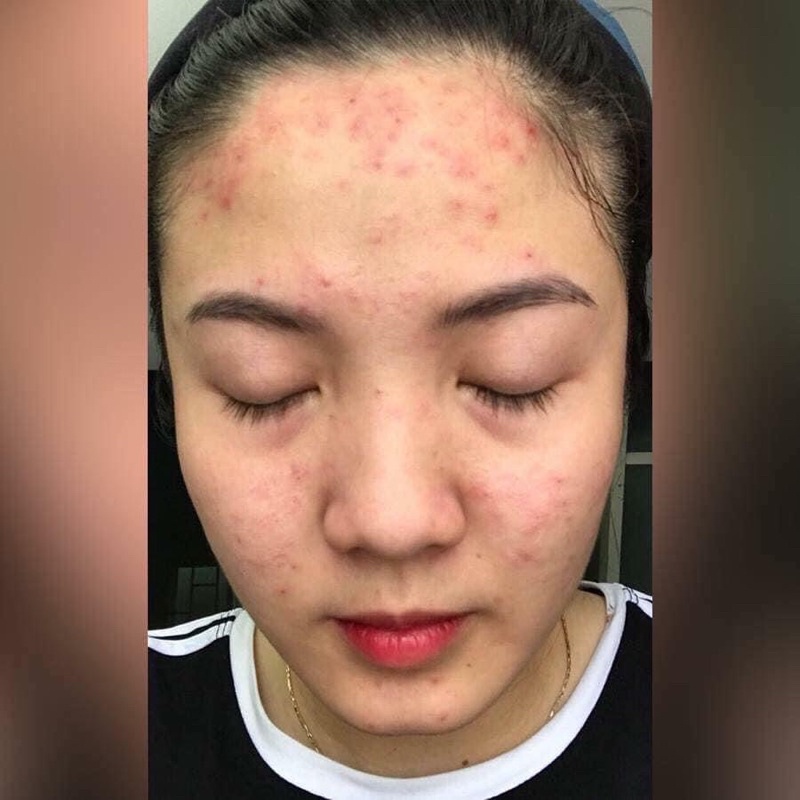 Kem bôi mụn Lưu Huỳnh của Nga, kem chấm mụn Cephar 30 gram