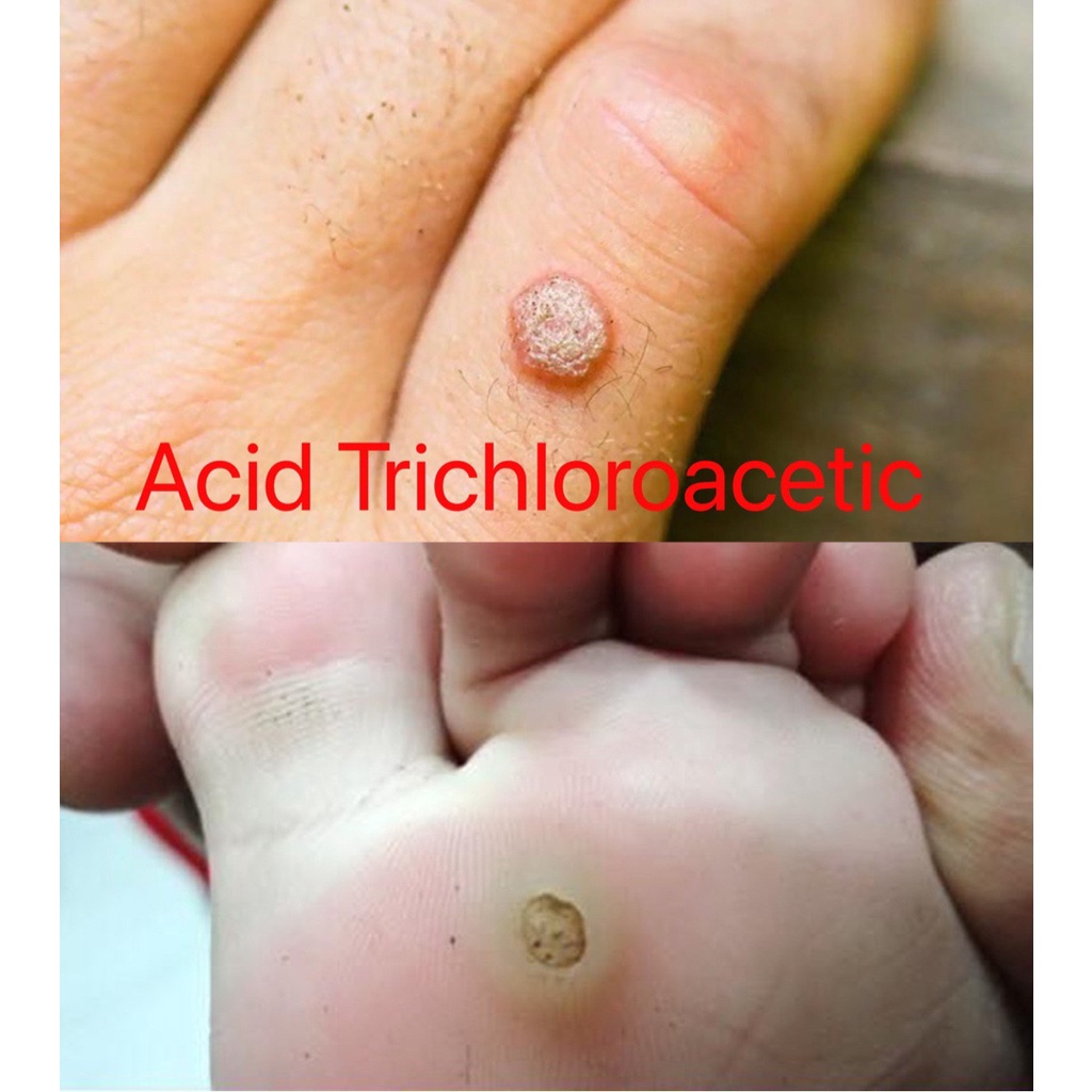 [Hàng mới về] Acid Trichloracetic 80% | MỤN CÓC, MỤN CƠM, MỤN THỊT, SÙI MÀO GÀ