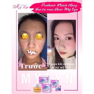 Acne Mỹ Lyn