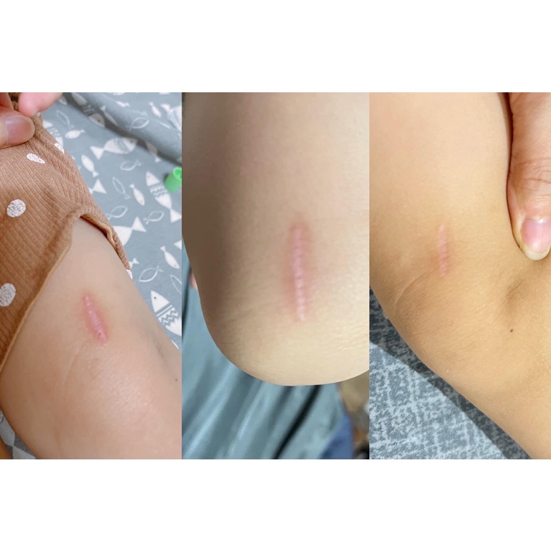 Kem ngừa sẹo Gentacin 10g của Nhật Bản