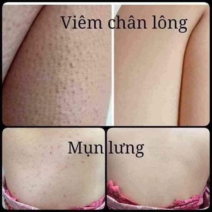 Xà phòng giảm mụn lưng viêm nang lông - Nội địa Nga