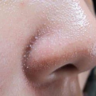 GEL HÚT MỤN DR.ACNE