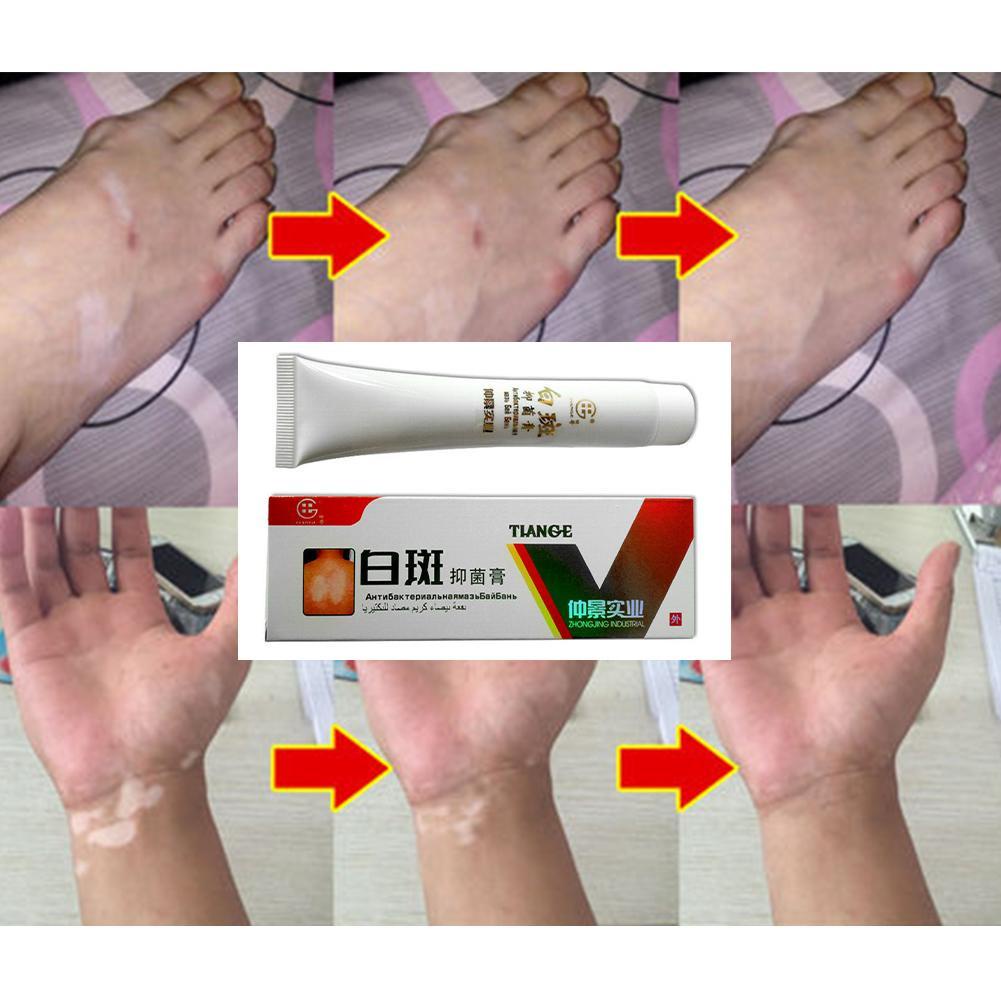 Kem dưỡng trắng da cao cấp Vitiligo 30g