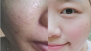 Serum đỏ dưỡng da Siberica - Nga