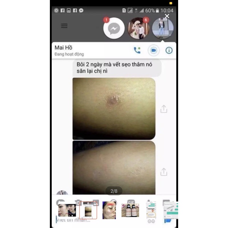 Serum làm lành vết sẹo lồi , sẹo lõm, sẹo rỗ nhanh chóng OfLe Nhật bản