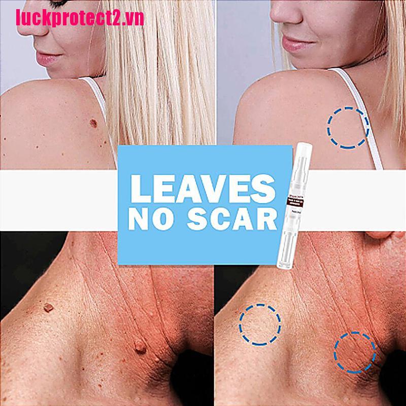 H&L Tu kill Remover Skin Tag Mole & Genital Wart Remover Foot Corn Removal Skin Care