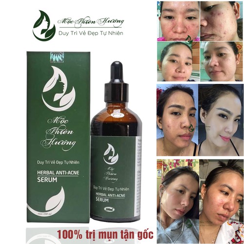 Serum Hết Mụn, Sạch Thâm, Tái Tạo Da | Herbal Anti Acne Serum 100ml Mộc Thiên Hương