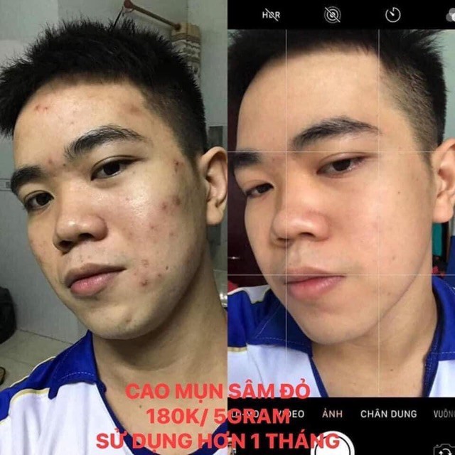 36VỊ - CAO MỤN SÂM ĐỎ 15GR | BigBuy360 - bigbuy360.vn