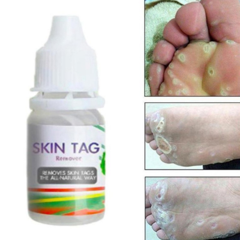 Skin Tag Remover 12 Hours Tu Kill Tu Kill Remover Skin Tag Mole & Genital Wart Remover Foot Corn Removal 10Ml