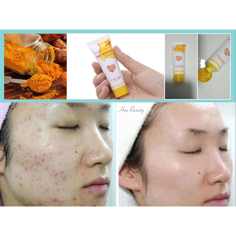 Kem nghệ Thái dương mờ sẹo mờ thâm giảm trứng cá mụn nhọt côn trùng cắn,hắc lào lang ben,làm mịn da sáng da - Tuýp 20g