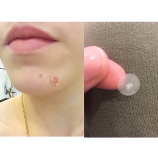 Miếng dán hút mụn Hàn Quốc