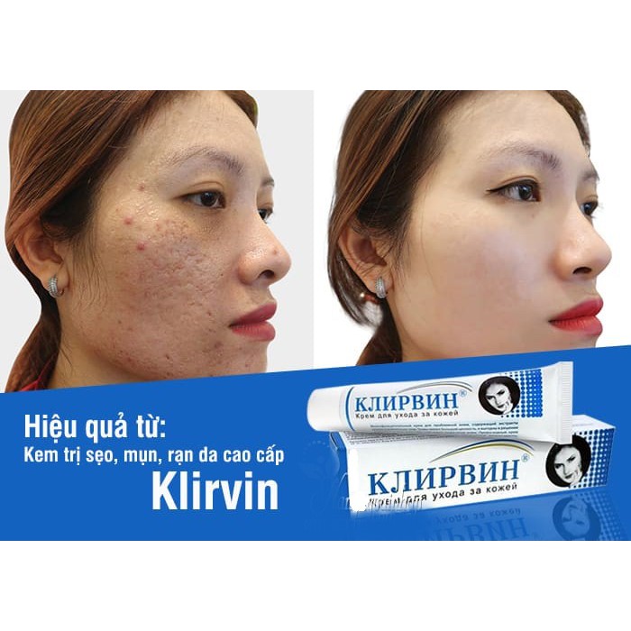 Kem mờ sẹo, rạn da cao cấp Klirvin 25g của Nga