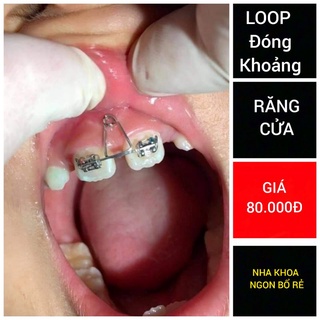 Loop đóng khoảng răng cửa