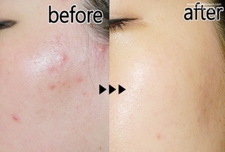 TRỊ MỤN VIÊM BENZAC 5 ( BENZOYL PEROXIDE )