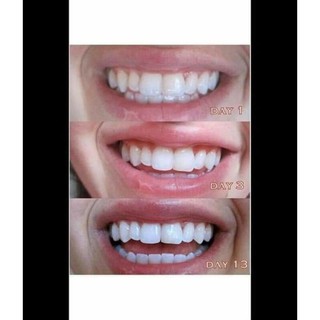 Bộ làm trắng răng White Gio White Accelerator Blue Light Teeth Úc