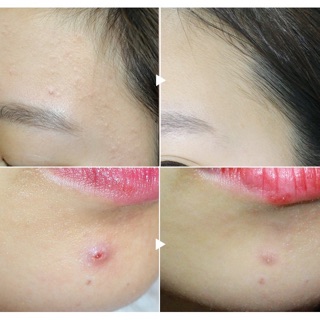 Kem trị sẹo Nhật Gentacin