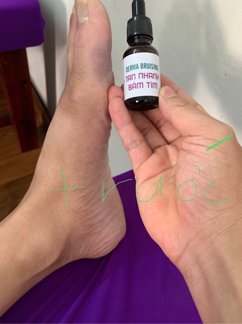 Gel bôi tan nhanh bầm tím - giảm sưng nề do chấn thương-sau thẩm mỹ DERMA BRUISING