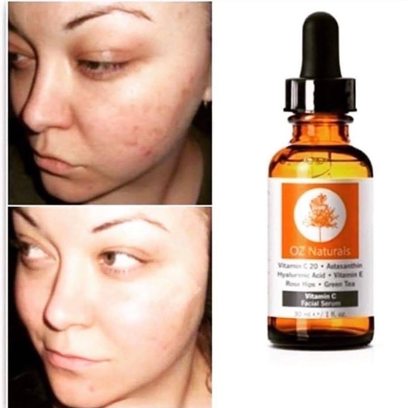 Tinh chất Vitamin C 20% sáng da, mờ thâm, chống lão hoá Oznaturals Serum