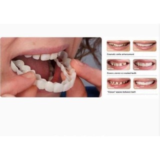 Nẹp răng Snapon Smile