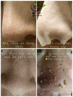 Ủ mụn ohio